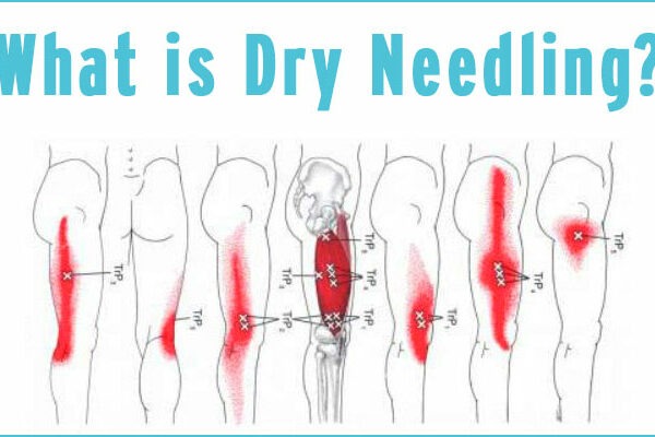 Dry Needling