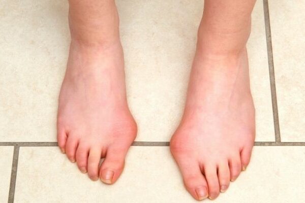 What Causes Bunions? The Painful Condition