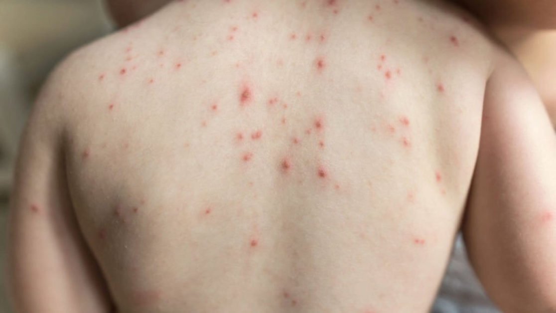 Shingles Symptoms, Causes, And Treatment
