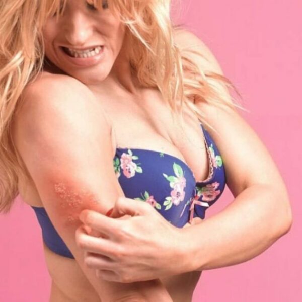 Shingles Symptoms, Causes, Treatment