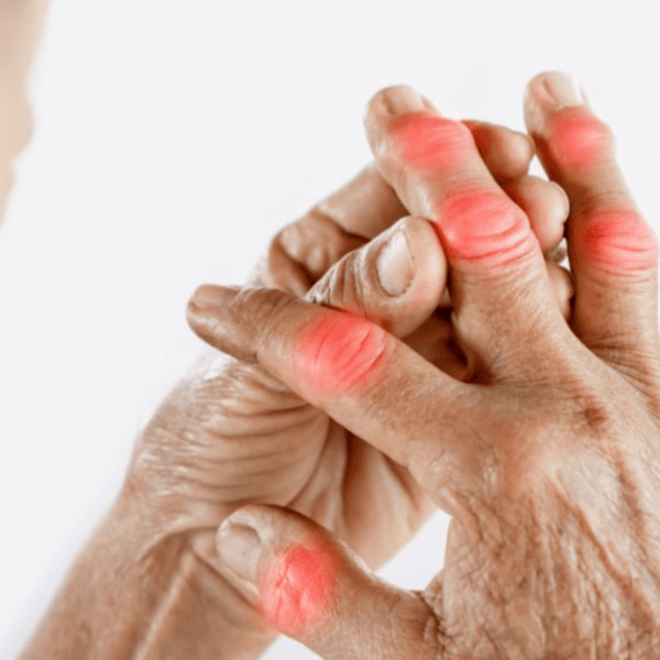 Different Stages Of Rheumatoid Arthritis