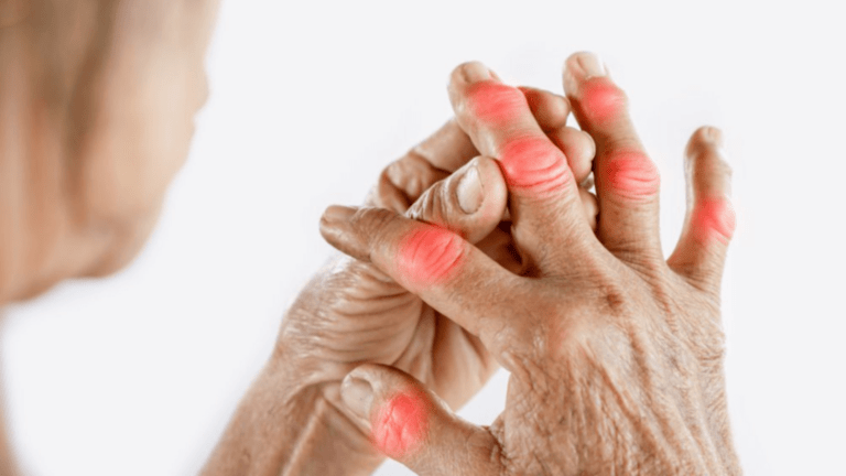 Different Stages Of Rheumatoid Arthritis