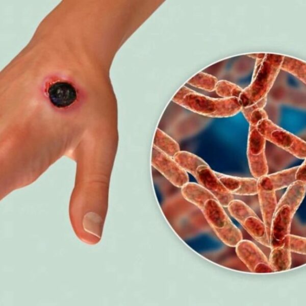 The Causes, Symptoms, And Treatment Of Anthrax