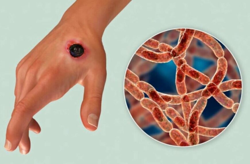 What Are The Causes, Symptoms, And Treatment Of Anthrax?