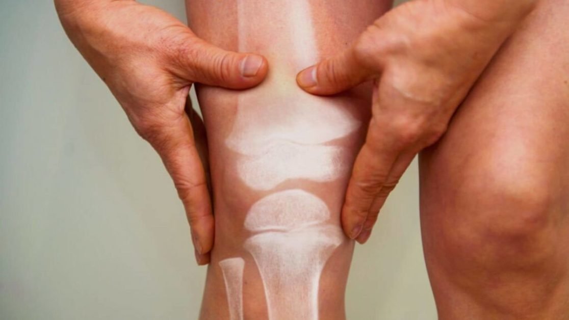 What To Do If You Think You Have Arthritis Symptoms And Remedies
