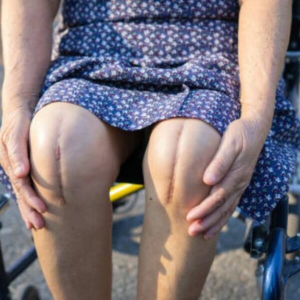 How Painful Is Total Knee Replacement-Treatment And Benefits Of Surgery