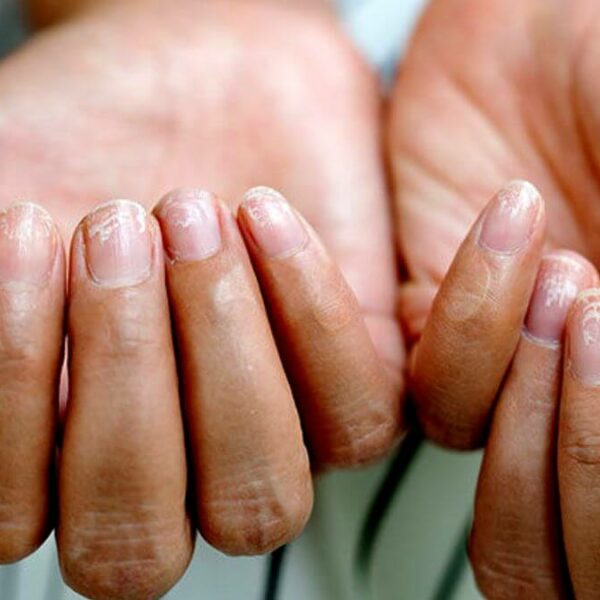 7 Possible Causes Of Fingernail Pain