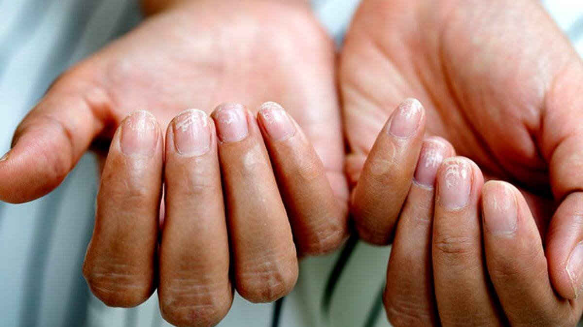 7 Possible Causes Of Fingernail Pain