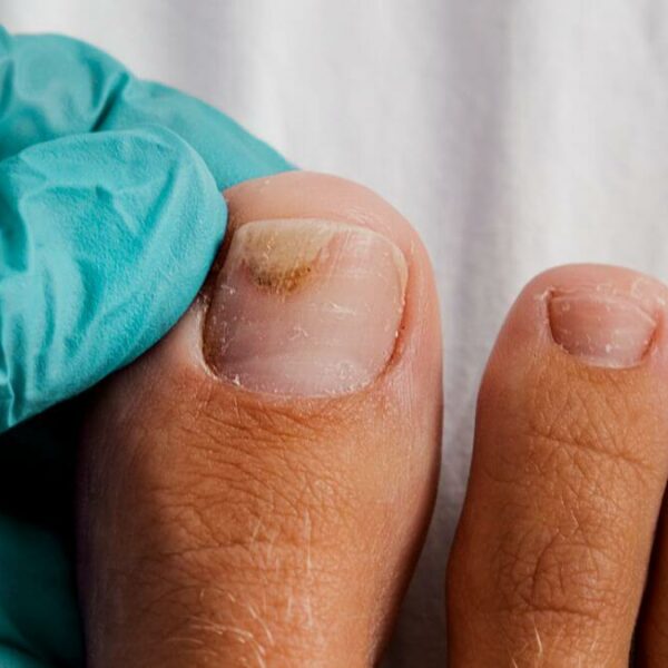 Toenail Falling Off: What To Do? Things To Note!