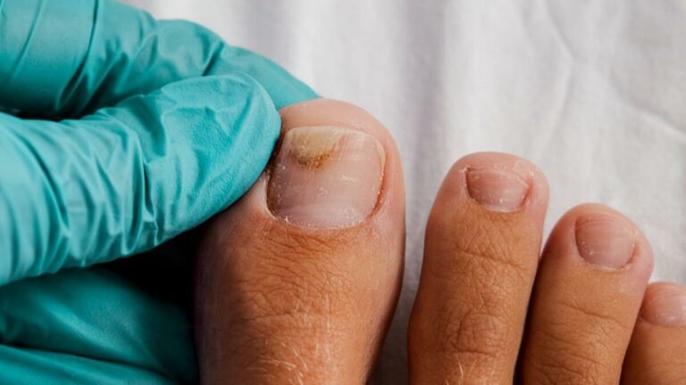 Toenail Falling Off: What To Do? Things To Note!