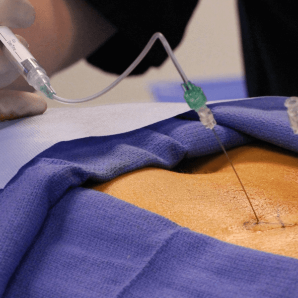 Epidural Injection For Back Pain – Benefits And Side Effects!