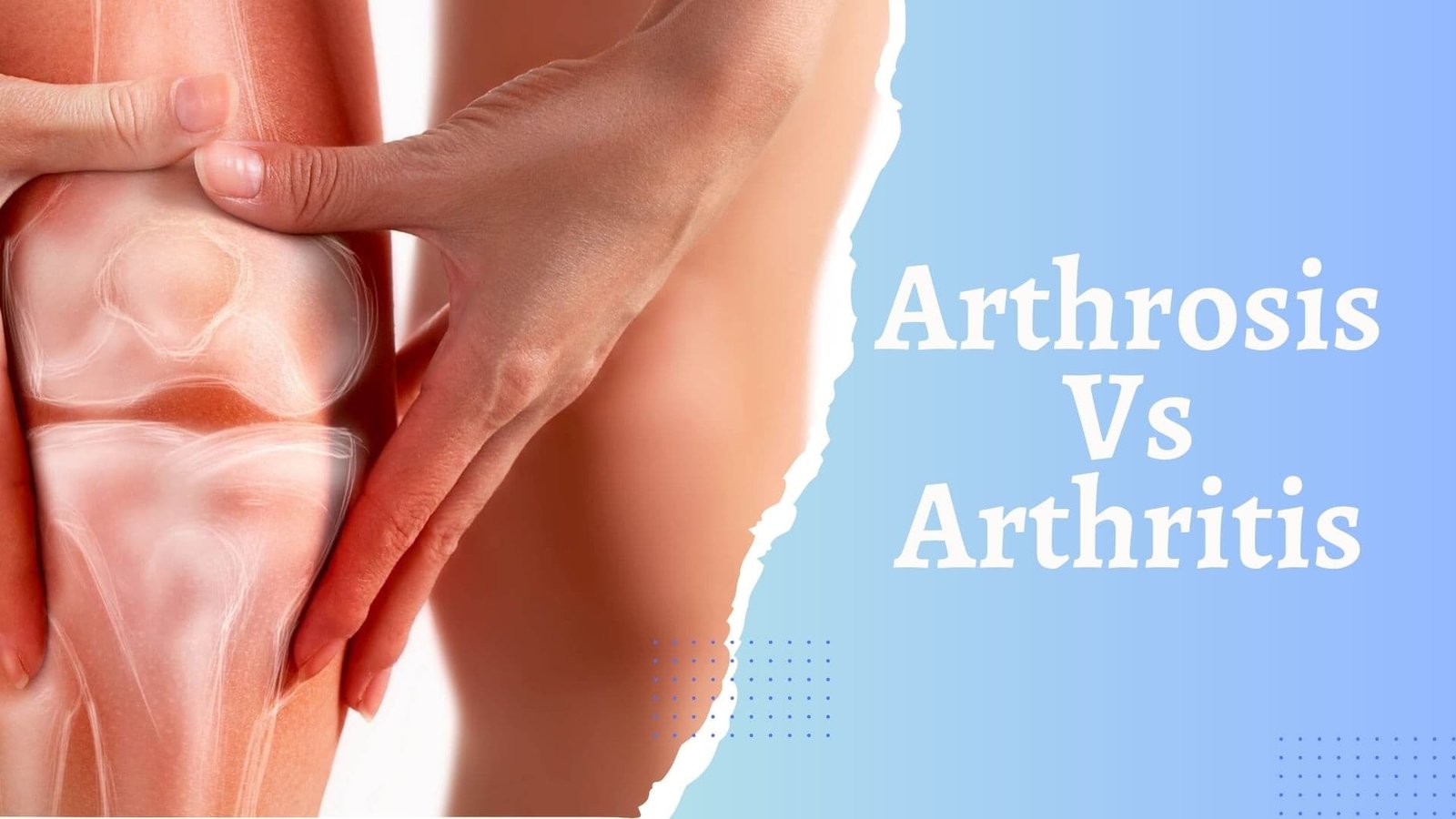 Arthrosis Vs Arthritis